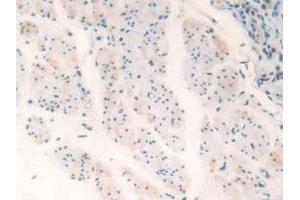 Detection of TP53TG5 in Human Esophagus Cancer Tissue using Polyclonal Antibody to TP53 Target Gene 5 (TP53TG5) (TP53TG5 抗体  (AA 190-262))