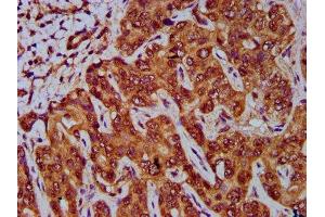 IHC image of ABIN7154731 diluted at 1:400 and staining in paraffin-embedded human liver cancer performed on a Leica BondTM system. (GNA12 抗体  (AA 112-270))