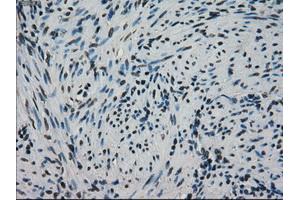 Immunohistochemical staining of paraffin-embedded Adenocarcinoma of ovary tissue using antiHSPA9mouse monoclonal antibody. (HSPA9 抗体)