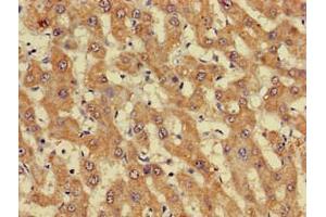 Immunohistochemistry of paraffin-embedded human liver cancer using ABIN7162738 at dilution of 1:100 (GIPC1 抗体  (AA 7-74))