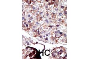 Formalin-fixed and paraffin-embedded human hepatocellular carcinoma tissue reacted with SPHK2 polyclonal antibody  , which was peroxidase-conjugated to the secondary antibody, followed by AEC staining. (SPHK2 抗体  (N-Term))