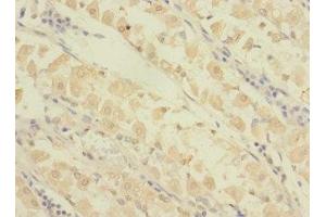 Immunohistochemistry of paraffin-embedded human gastric cancer using ABIN7154384 at dilution of 1:100 (GRAMD1B 抗体  (AA 235-504))