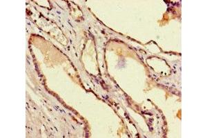 Immunohistochemistry of paraffin-embedded human prostate cancer using ABIN7172691 at dilution of 1:100