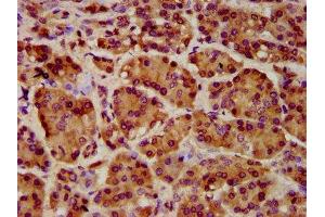 IHC image of ABIN7151354 diluted at 1:1000 and staining in paraffin-embedded human pancreatic cancer performed on a Leica BondTM system. (ART5 抗体  (AA 45-291))