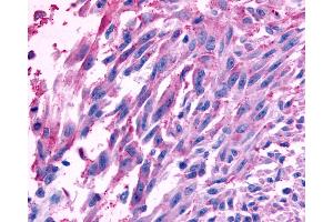 Anti-FZD10 / Frizzled 10 antibody IHC of human Skin, Melanoma. (FZD10 抗体  (N-Term))