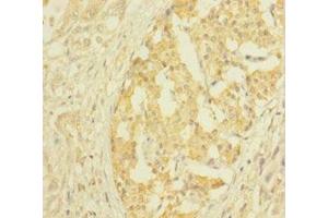 Immunohistochemistry of paraffin-embedded human pancreatic cancer using ABIN7147859 at dilution of 1:100 (CLTB 抗体  (AA 1-211))