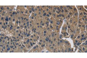 Immunohistochemistry of paraffin-embedded Human liver cancer using SIGMAR1 Polyclonal Antibody at dilution of 1:50 (SIGMAR1 抗体)