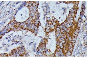 Immunohistochemistry of paraffin-embedded Human colon carcinoma using HMGCS2 Polyclonal Antibody at dilution of 1:100 (40x lens). (HMGCS2 抗体)