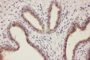 Anti-RTN3 antibody, IHC(P) IHC(P): Human Mammary Cancer Tissue (Reticulon 3 抗体  (C-Term))