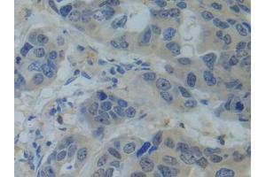 IHC-P analysis of Human Breast cancer Tissue, with DAB staining. (SNRPC 抗体  (AA 2-159))