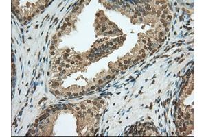 Immunohistochemical staining of paraffin-embedded Adenocarcinoma of Human ovary tissue using anti-PDE4A mouse monoclonal antibody. (PDE4A 抗体)