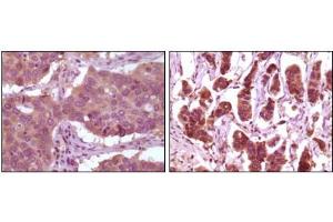 Immunohistochemical analysis of paraffin-embedded human lung carcinoma (left) and breast carcinoma (right) showing cytoplasmic localization using ERK2 mouse mAb with DAB staining. (ERK2 抗体)