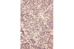 Anti-FGF19 antibody, IHC(P) IHC(P): Human Gallbladder Cancer Tissue (FGF19 抗体  (Middle Region))