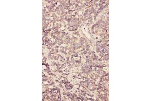 Anti-FGF19 antibody, IHC(P) IHC(P): Human Gallbladder Cancer Tissue