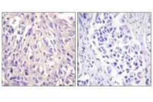 Immunohistochemistry analysis of paraffin-embedded human breast carcinoma tissue using UBE1L antibody. (UBA7 抗体  (C-Term))