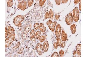 IHC-P Image Immunohistochemical analysis of paraffin-embedded human gastric cancer, using Cathepsin O, antibody at 1:100 dilution. (CTSO 抗体)