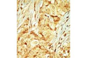 Formalin-fixed and paraffin-embedded human cancer tissue reacted with the primary antibody, which was peroxidase-conjugated to the secondary antibody, followed by DAB staining. (RAGE 抗体  (C-Term))
