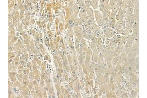 ABIN6266258 and ABIN6277419 at 1/100 staining human hepatocellular carcinoma by IHC-P. (P2RY11 抗体  (C-Term))