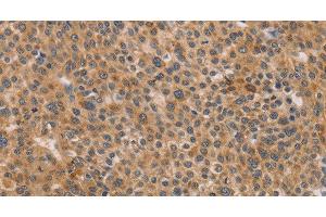 Immunohistochemistry of paraffin-embedded Human liver cancer using CDK11B Polyclonal Antibody at dilution of 1:40 (CDK11 抗体)
