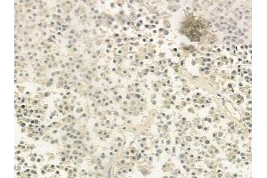 ABIN6260386 and ABIN6279208 at 1/100 staining human pituitary adenoma by IHC-P. (CABIN1 抗体  (Internal Region))