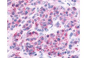 Anti-AVPR2 / V2R antibody IHC of human Breast, Carcinoma. (AVPR2 抗体  (Cytoplasmic Domain))