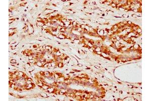 IHC image of ABIN7152644 diluted at 1:300 and staining in paraffin-embedded human breast cancer performed on a Leica BondTM system. (FAR1 抗体  (AA 182-343))