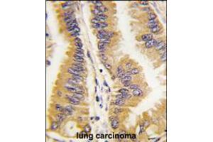 Formalin-fixed and paraffin-embedded human lung carcinoma tissue reacted with FRAT1 antibody , which was peroxidase-conjugated to the secondary antibody, followed by DAB staining.