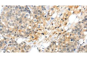 Immunohistochemistry of paraffin-embedded Human liver cancer tissue using KCNG3 Polyclonal Antibody at dilution 1:40 (KCNG3 抗体)