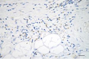 Immunohistochemistry was performed on paraffin-embedded human sigmoid colon carcinoma using ADAM17 antibody (ABIN7797502), 1:200). (Recombinant ADAM17 抗体)