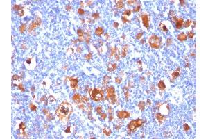 Formalin-fixed, paraffin-embedded human Hodgkin's Lymphoma stained with Fascin-1 Mouse Monoclonal Antibody (FSCN1/418). (Fascin 抗体)