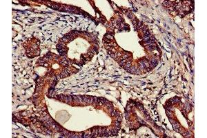 Immunohistochemistry of paraffin-embedded human colon cancer using ABIN7147780 at dilution of 1:100 (CNTF Receptor alpha 抗体  (AA 106-342))
