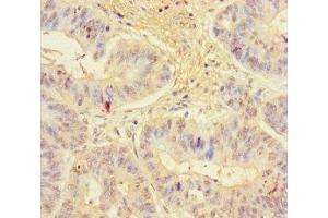 Immunohistochemistry of paraffin-embedded human colon cancer using ABIN7157538 at dilution of 1:100 (KLRG1 抗体  (AA 60-195))