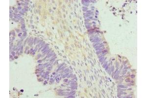 Immunohistochemistry of paraffin-embedded human ovarian cancer using ABIN7155889 at dilution of 1:100 (HERPUD1 抗体  (AA 1-240))