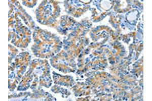 The image on the left is immunohistochemistry of paraffin-embedded Human thyroid cancer tissue using ABIN7190321(COG1 Antibody) at dilution 1/60, on the right is treated with synthetic peptide. (COG1 抗体)