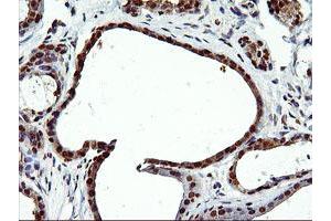 Immunohistochemical staining of paraffin-embedded Human breast tissue using anti-EPM2AIP1 mouse monoclonal antibody. (EPM2AIP1 抗体)