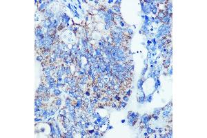 Immunohistochemistry of paraffin-embedded human colon carcinoma using MMP13 Rabbit mAb (ABIN7268419) at dilution of 1:100 (40x lens). (MMP13 抗体)