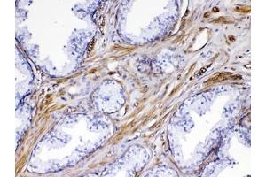 IHC testing of FFPE human prostate cancer tissue with VEGF Receptor 3 antibody at 1ug/ml. (FLT4 抗体)