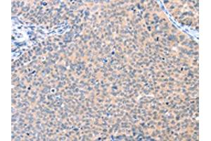 The image on the left is immunohistochemistry of paraffin-embedded Human cervical cancer tissue using ABIN7128109(AADACL2 Antibody) at dilution 1/25, on the right is treated with fusion protein. (AADACL2 抗体)