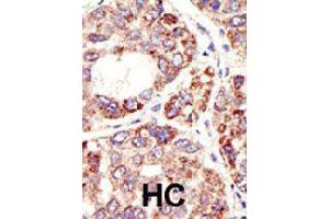 Formalin-fixed and paraffin-embedded human hepatocellular carcinoma tissue reacted with MDM2 polyclonal antibody  , which was peroxidase-conjugated to the secondary antibody, followed by DAB staining. (MDM2 抗体  (C-Term))