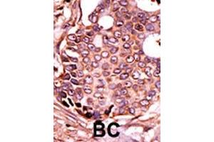 Formalin-fixed and paraffin-embedded human cancer tissue reacted with the primary antibody, which was peroxidase-conjugated to the secondary antibody, followed by DAB staining. (SEPSH2 抗体  (AA 171-201))