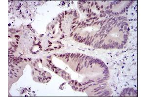 Immunohistochemical analysis of paraffin-embedded colon cancer tissues using FOS mouse mAb with DAB staining.