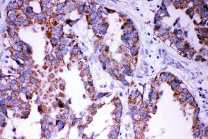 Anti- DISC1 antibody,  IHC(P) IHC(P): Human Lung Cancer Tissue (DISC1 抗体  (N-Term))