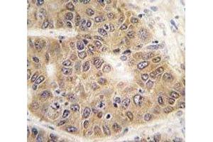 IHC analysis of FFPE human hepatocarcinoma tissue stained with SUMO4 antibody (SUMO4 抗体  (Met55Val-Mutant))