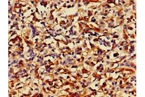 Immunohistochemistry of paraffin-embedded human melanoma using ABIN7168489 at dilution of 1:100 (RUNX3 抗体  (AA 1-415))