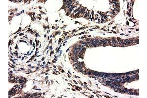 Immunohistochemical staining of paraffin-embedded Adenocarcinoma of Human colon tissue using anti-CYB5R3 mouse monoclonal antibody. (CYB5R3 抗体)