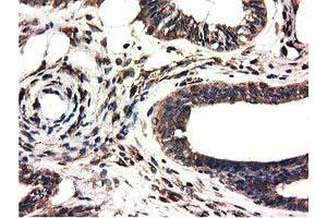 Immunohistochemical staining of paraffin-embedded Adenocarcinoma of Human colon tissue using anti-CYB5R3 mouse monoclonal antibody.