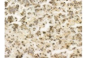 ABIN6265320 and ABIN6269360 at 1/100 staining human melanoma by IHC-P.