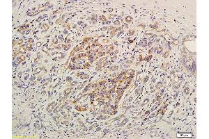 Formalin-fixed and paraffin embedded human pancreatic cancer labeled with Anti-EDG7/LPA3 Polyclonal Antibody, Unconjugated (ABIN681133) at 1:400 followed by conjugation to the secondary antibody and DAB staining (LPAR3 抗体  (AA 101-200))