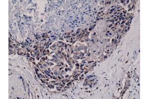 Immunohistochemical staining (Formalin-fixed paraffin-embedded sections) of human breast cancer with AKT (phospho S473) monoclonal antibody, clone RM251 . (AKT1 抗体  (pSer473))