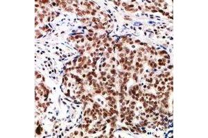Immunohistochemical analysis of TP53INP2 staining in human breast cancer formalin fixed paraffin embedded tissue section.